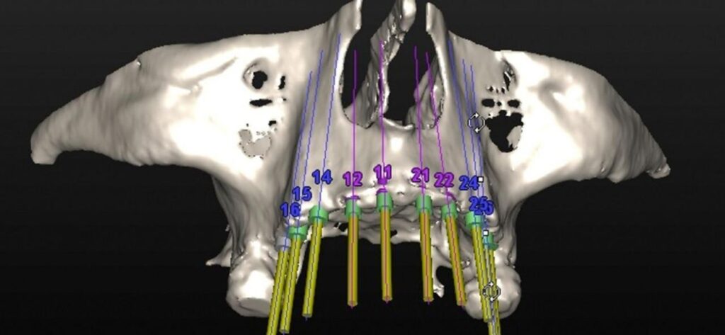 Cirugía Guiada Implantes Dentales - Molina de Segura | MOLIDENT